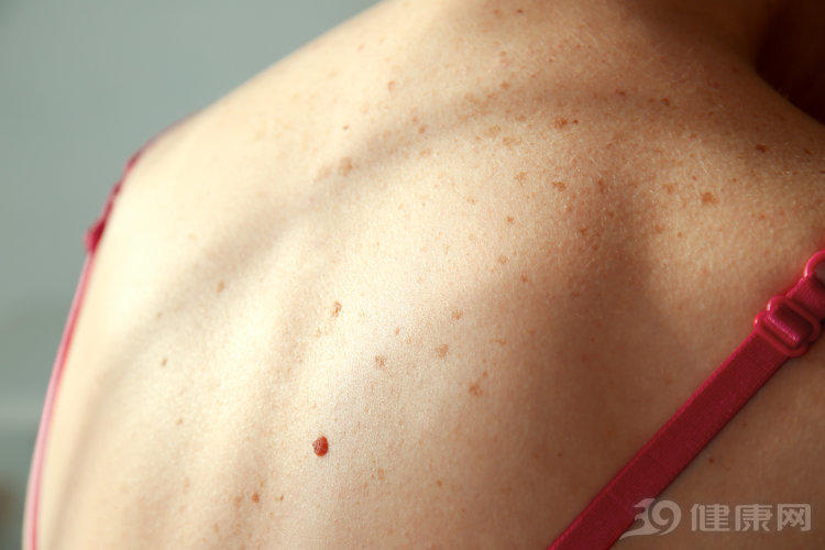 女子身上长红点,确诊肝癌.医生:皮肤这1变化或是肝癌前兆