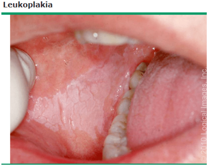 1 口腔白斑 颊黏膜上的白色斑块 2 口腔增生性疣状白斑 口腔增生性疣