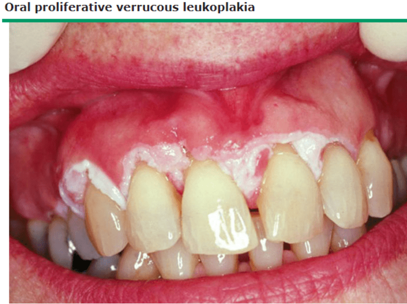 2 口腔增生性疣状白斑 口腔增生性疣状白斑患者牙龈边缘广泛的白色疣