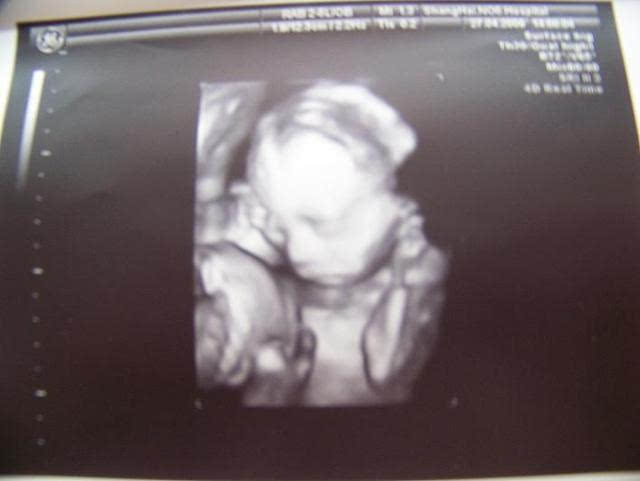 孕妈妈怀上的双胞胎有点特殊,剖腹产时医生拍