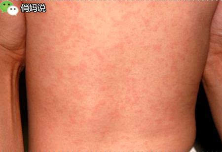诊断时切记是高烧持续3天以上退热后随即出现的红疹子,也就是"热退疹