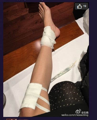 在另一张已经进行包扎的照片中,不仅是脚踝处,她的膝盖处也包了一大块