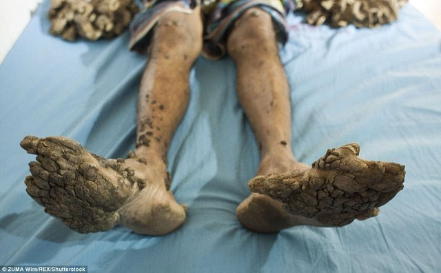 孟加拉国男子患罕见病 手脚增生如树根(组图)