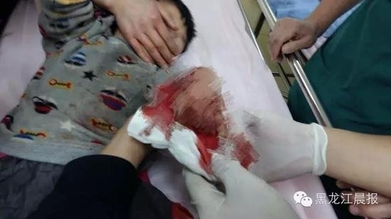 哈尔滨燃放鞭炮第一天 4岁男孩被炸烂手(图)