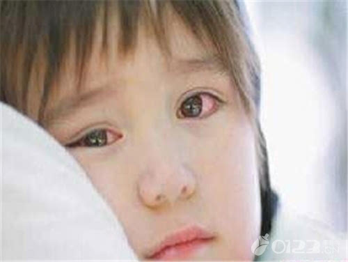 春季儿童红眼病高发 预防红眼病从洗手开始!