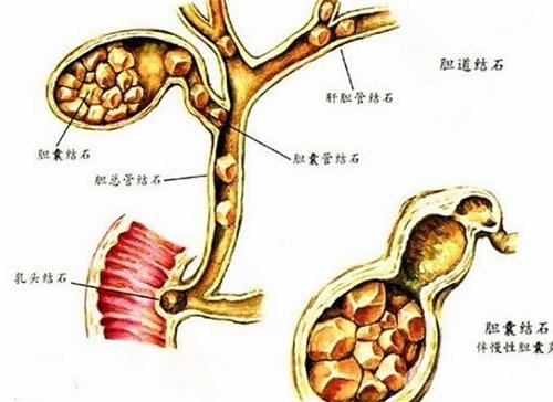 狗结石_肝内胆管结石症状_狗结石症状