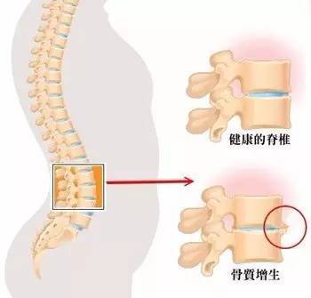 预防腰椎骨质增生,从现在开始!