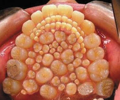 女童嘴巴莫名肿痛:医生竟拔出202颗牙齿