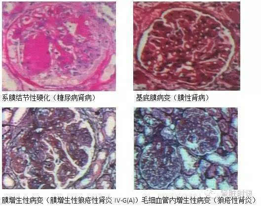 原发性和继发性肾小球疾病