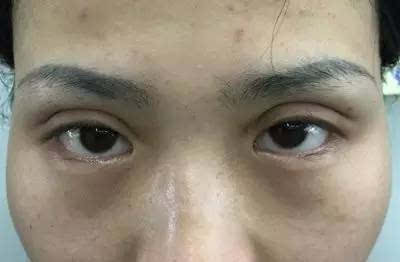 双眼皮手术失败案例