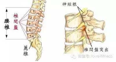 轻微腰椎间盘突出,这样练很有效!