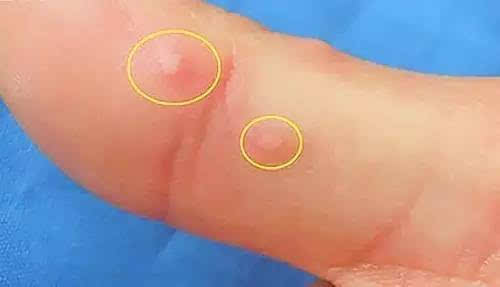 区分手足口与水痘,别自己吓自己 1,两者疹子形态不一样,水痘的特点
