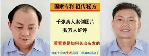 30天秃顶变男神,防脱生发,还自信的你一头
