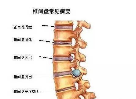 腰椎病变