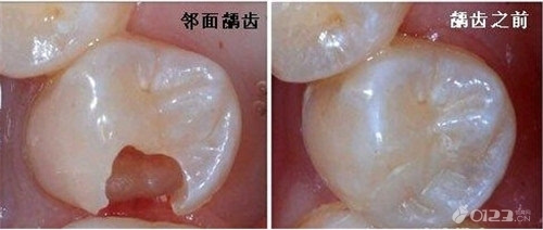 蛀牙赶紧医,否则影响孩子发音 儿童龋齿有何危害?