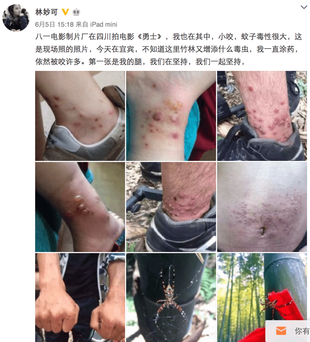 好吓人!林妙可自曝竹海拍戏被"毒虫"咬得满腿包,好友送来驱蚊药