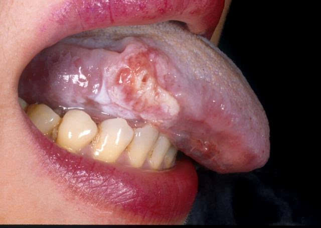 舌体溃疡反复不愈,23岁的她确诊舌癌7个月就离开了人世