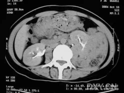 经典胸部 CT 从淋巴管平滑肌瘤病拓展(上)