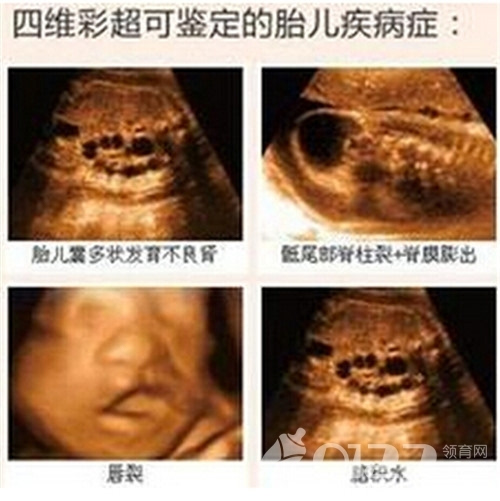 胎儿脑膨出被预测活不久 出生后奇迹长大