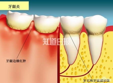 牙龈炎如不治疗,继续发展可侵犯深部牙周组织,发展为牙周炎,牙周炎的