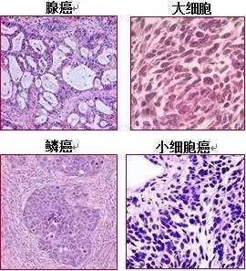 0版本里面,4种主要肺癌类型在显微镜下的不同样子.