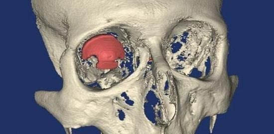 3d打印新技术 世界首个3d打印义眼诞生