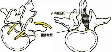 腰椎管侧隐窝狭窄  图为常见脊柱骨折  推荐阅读 微创脊柱外科系列—