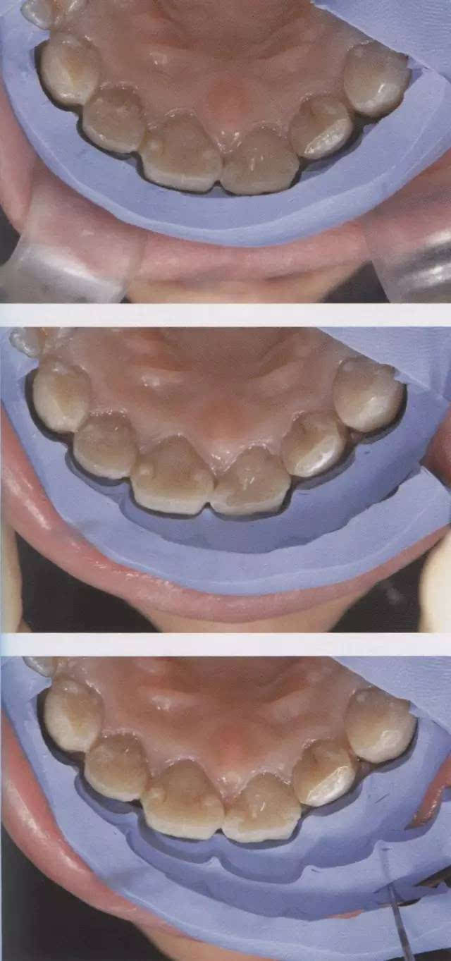[大师技术](下篇)贴面的牙体预备方法