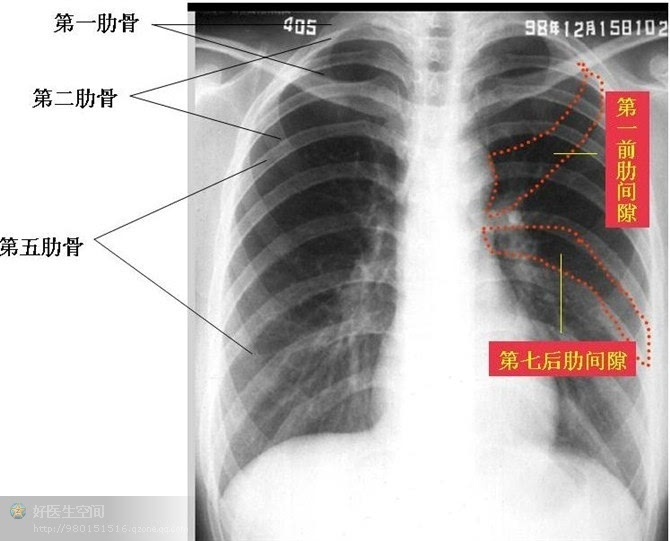 前纵隔胸骨后结节状软组织密度影,肿大淋巴结