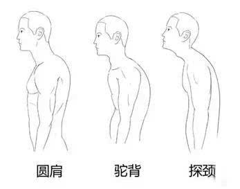 驼背和圆肩,才是你佝偻姿态的最大元凶!