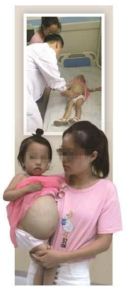 江苏女童小熙熙今年只有3岁,但肚子却大得犹如即将临盆的孕妇,她大如