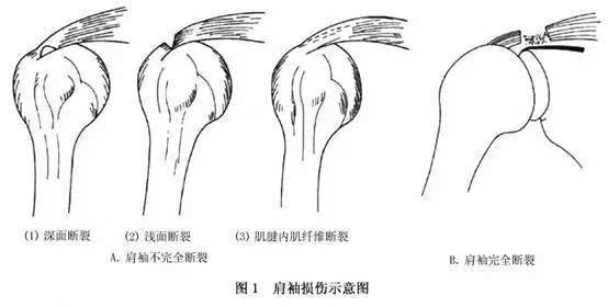 肩袖损伤惹的祸,你却让肩周炎来背锅!