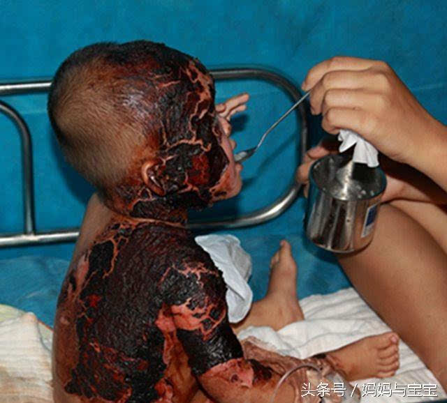 北京一名小婴儿,全身40%的皮肤给氢气球烧伤.