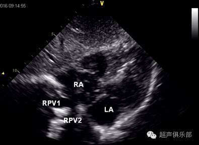 [心超笔记](42)迷路的小孩 肺静脉异位引流