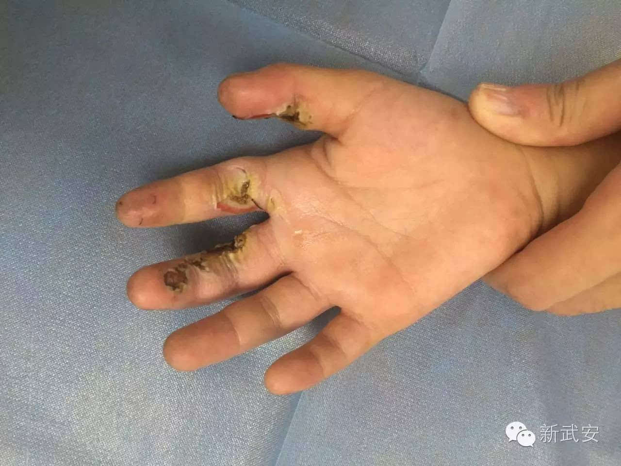 入院时手被电烧伤的照片