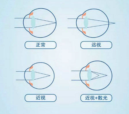 散光?近视?傻傻分不清楚~(1)