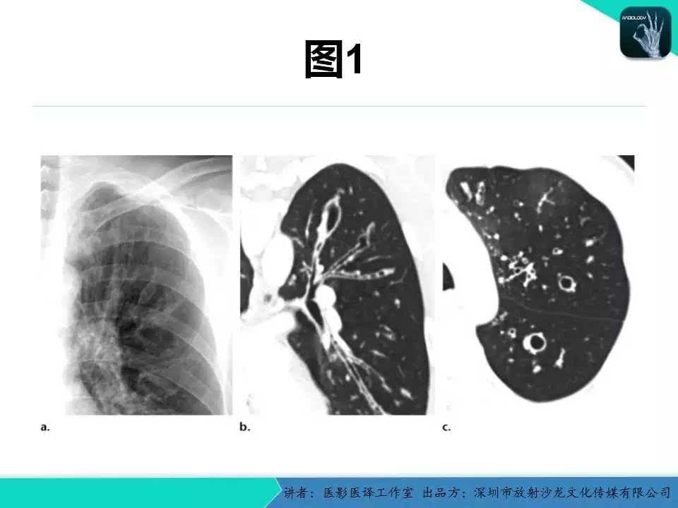 支气管扩张:相关常见及不常见疾病的机制及影像特征