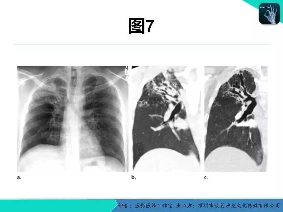 支气管扩张:相关常见及不常见疾病的机制及影像特征