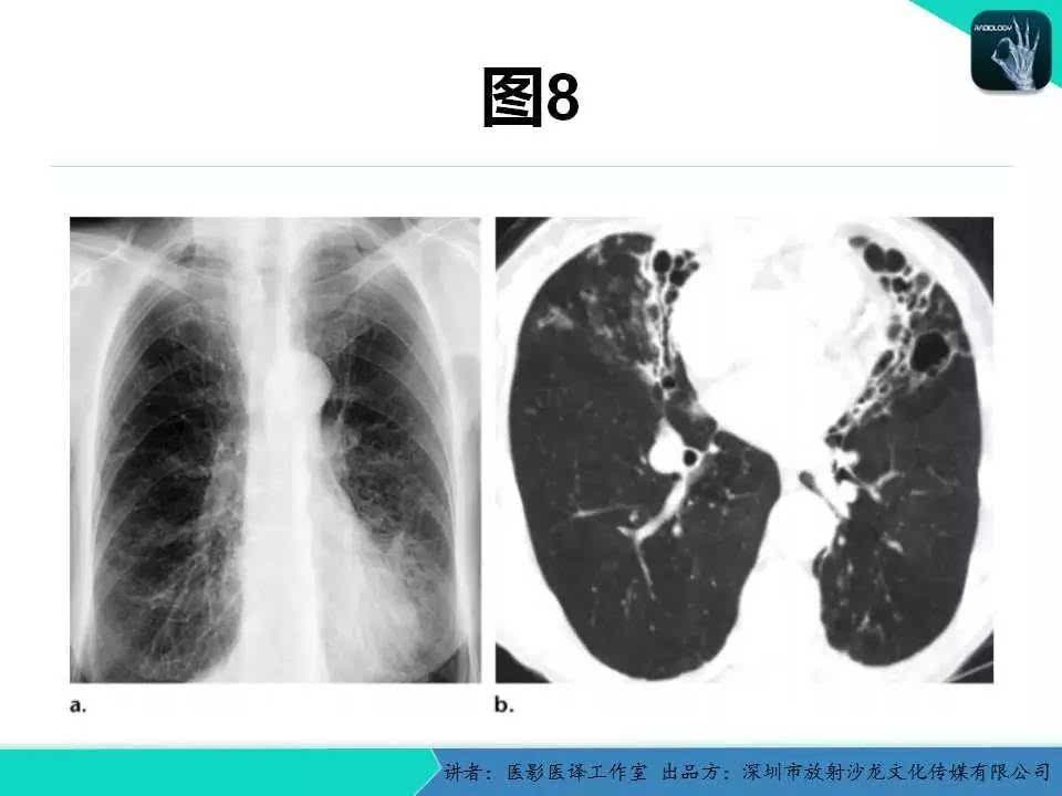 支气管扩张:相关常见及不常见疾病的机制及影像特征