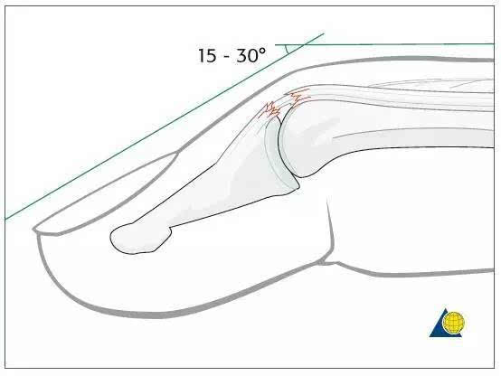 鹅颈畸形 由于伸肌腱末端断裂,伸肌力量集中到近指间关节,导致远指间
