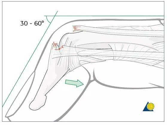 鹅颈畸形 由于伸肌腱末端断裂,伸肌力量集中到近指间关节,导致远指间