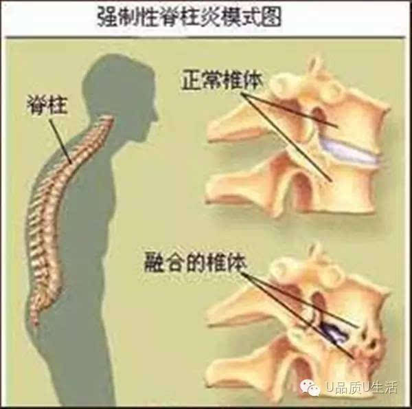 一个强直性脊柱炎患者的真实经历!