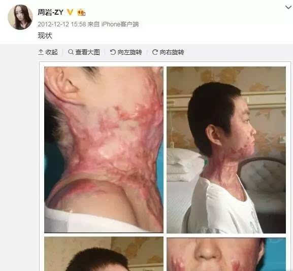 烧伤女孩周岩拍写真,她用5年时间诠释了什么叫"浴火
