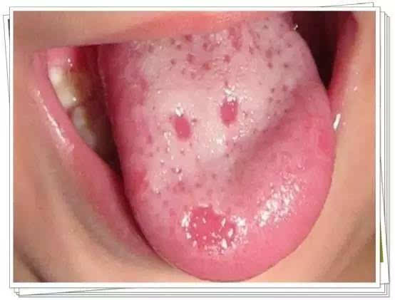 舌头拥有独一无二的"舌纹"?