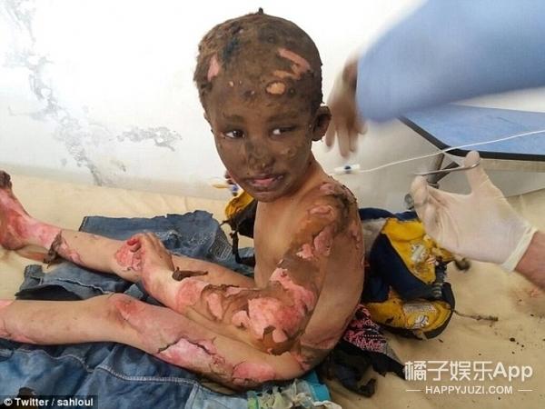 直击叙利亚战乱:烧伤大量儿童的"凝固汽油弹",到底是什么鬼!