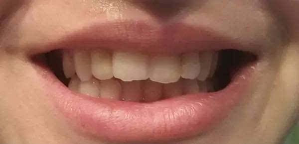 5分钟消除所有牙垢 过程太刺激(4)
