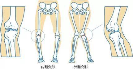 儿童膝外翻(x型腿)或膝内翻(o型腿)是临床常见的一种骨关节结构病变