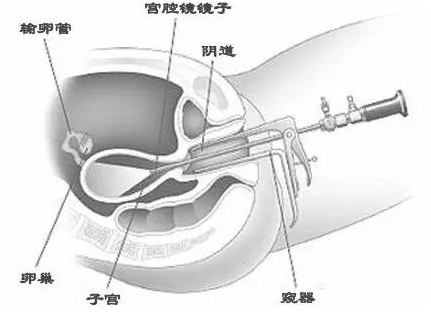 宫腔镜在诊断围绝经期异常子宫出血中的应用