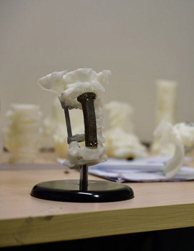 北医三院骨科团队应用3D打印技术解决又一世