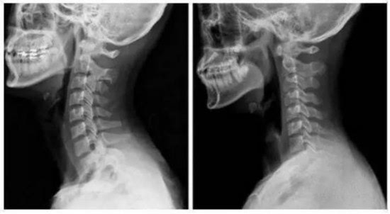 脖子不舒服  去医院拍片一看  医生说是颈椎出了问题  (左侧是正常人